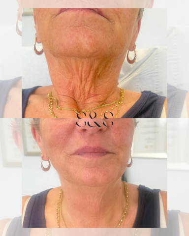 1 Session of Skin Tightening on Neck and Lower Face