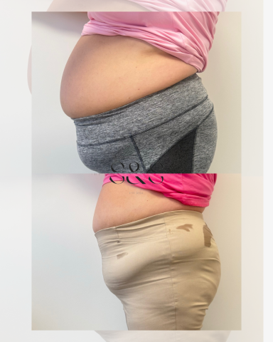 5 Sessions of Non Surgical Tummy Tuck