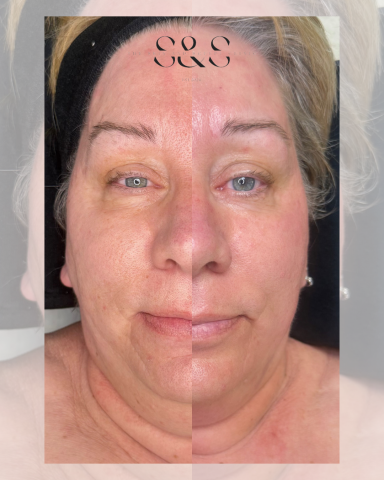 2 Sessions of Luxury Microneedling Facial
