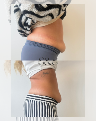 5 Sessions Non Surgical Tummy Tuck