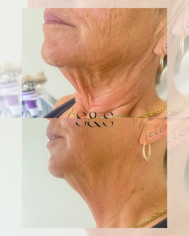 1 Session of Skin Tightening on Neck and Lower Face