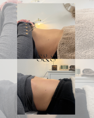 1 Session Non Surgical Tummy Tuck