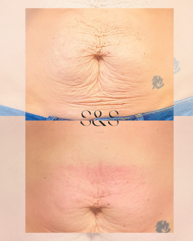 5 Sessions of Skin Tightening