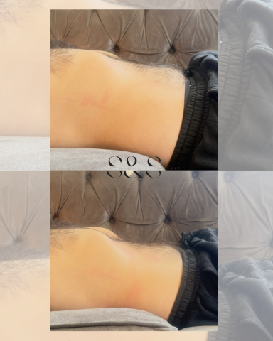 1 Session of Lymphatic Tummy Massage