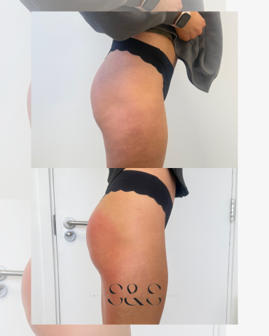 5 Sessions of Non Surgical BBL