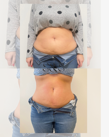 5 Sessions of Non Surgical Tummy Tuck