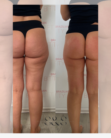 Express BBL Treatment