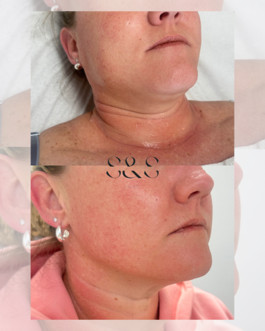 1 Session Non Surgical Face Lift