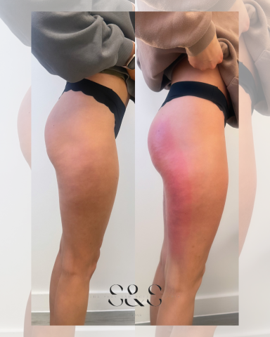 1 Session Non Surgical BBL