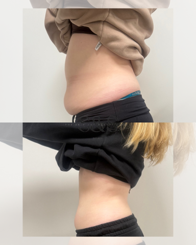 4 Sessions of Non Surgical Tummy Tuck