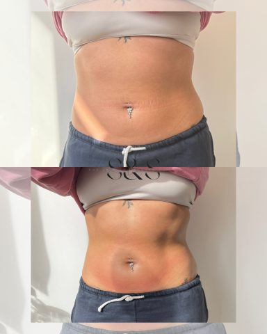 1 Session Non Surgical Tummy Tuck